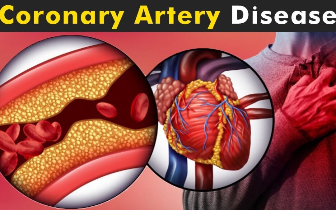 Coronary Heart Disease Overview – Symptoms – Treatment